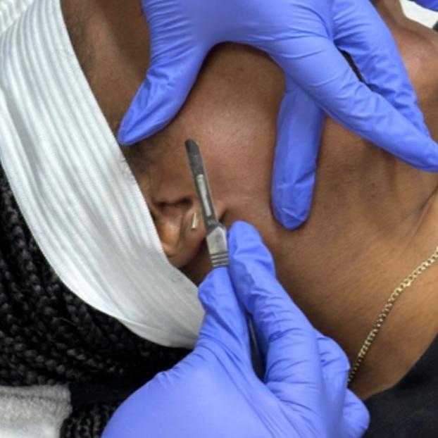 Corrective Peel + Dermaplaning